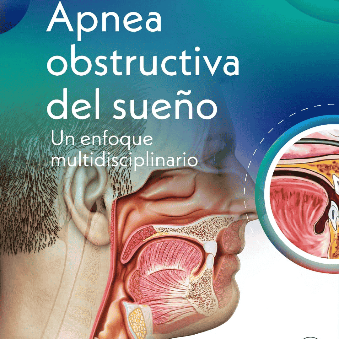 Apnea Obstructiva del Sueño - Un enfoque multidisciplinario