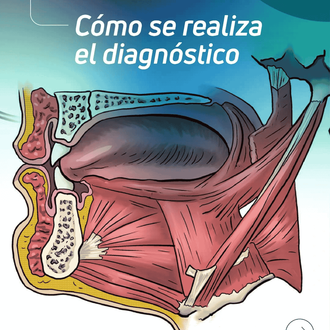 Apnea Obstructiva del Sueño - Un enfoque multidisciplinario