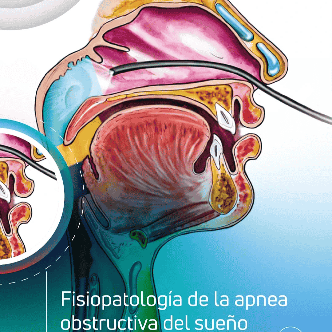 Apnea Obstructiva del Sueño - Un enfoque multidisciplinario