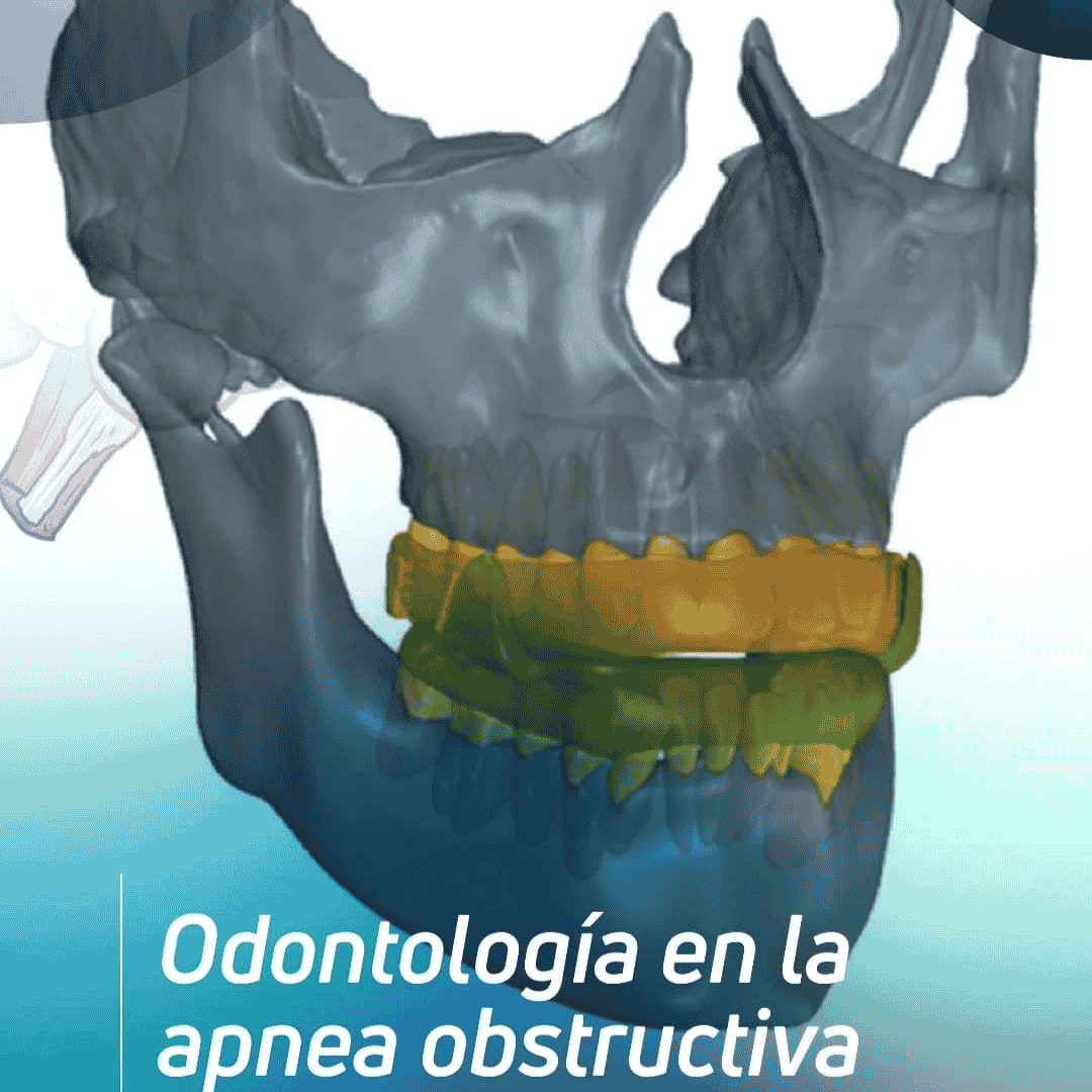 Apnea Obstructiva del Sueño - Un enfoque multidisciplinario
