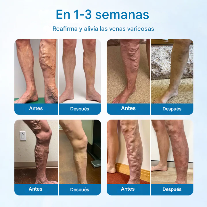 PROMO 2X1🔥VEINGUARD ®Clínicamente probado para eliminar las venas varicosas en solo 7 días!