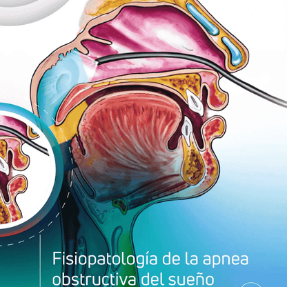 Apnea Obstructiva del Sueño - Un enfoque multidisciplinario