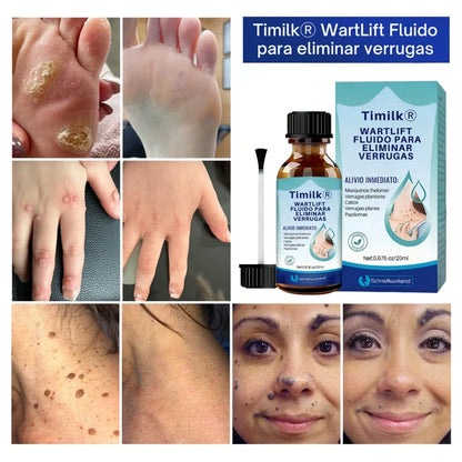 Timilk® WartLift Fluido para eliminar verrugas ✨