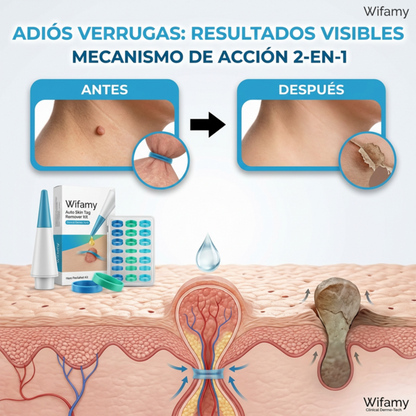 LigueWart® Terapia de eliminación a presión de verrugas 🛡️✂️ desprendimiento en 10 días