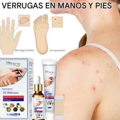 WART BLACKHEADS® │Removedor de verrugas│⭐⭐⭐⭐⭐