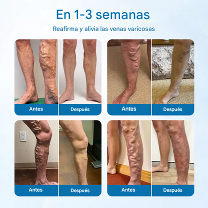 PROMO 2X1🔥VEINGUARD ®Clínicamente probado para eliminar las venas varicosas en solo 7 días!