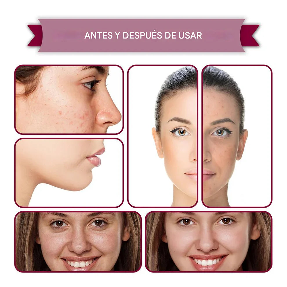 JAYSUING® Serum ANTIACNÉ coreano con Centella Asiática