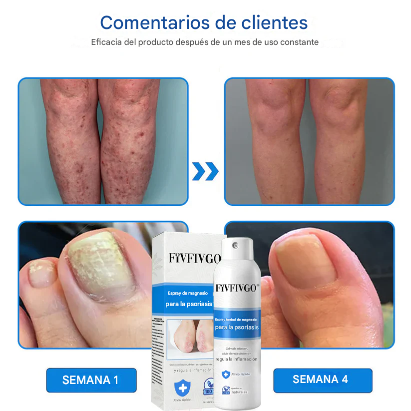 REGEM® Spray herbal de magnesio para la psoriasis